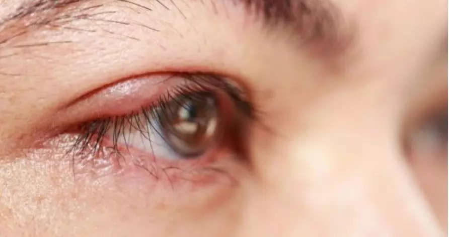 Eyelid Inflammation 