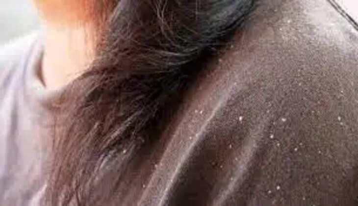 dandruff